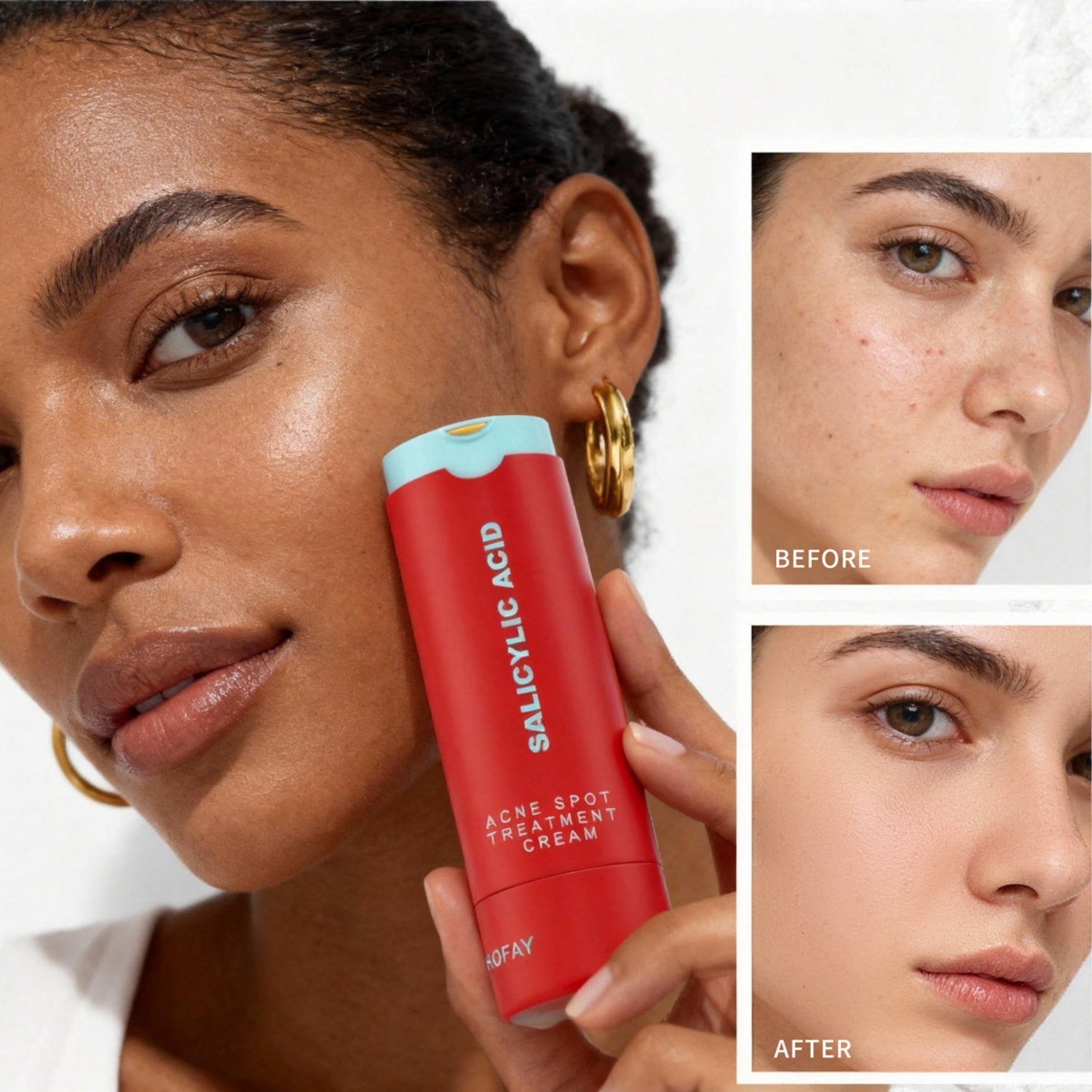 Acne Removing Lotion – Lightweight Anti-Blemish Treatment