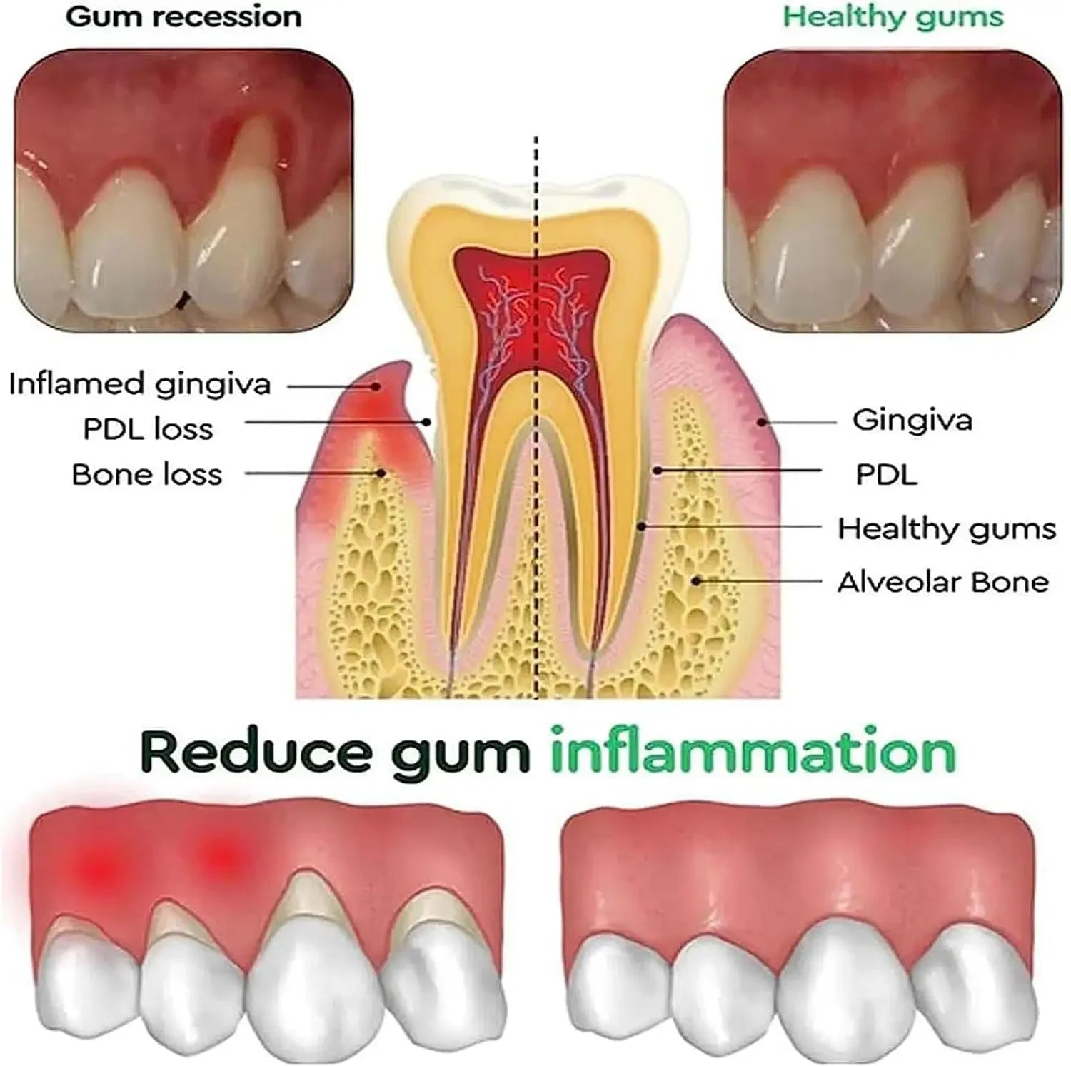 Gel de reparación rápida de encías, alivia eficazmente la alergia dental, caries, limpieza dental, pasta de dientes, alivia el suero de daños en los dientes