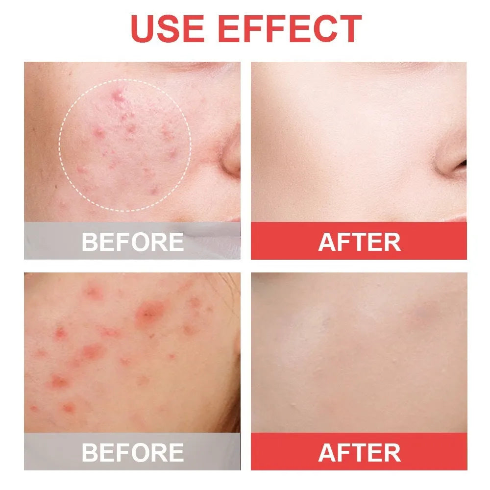 Acne Patches-Invisible Acne PATCHES-144 - Bellarte Enchanté Acne Patches-Invisible Acne PATCHES-144