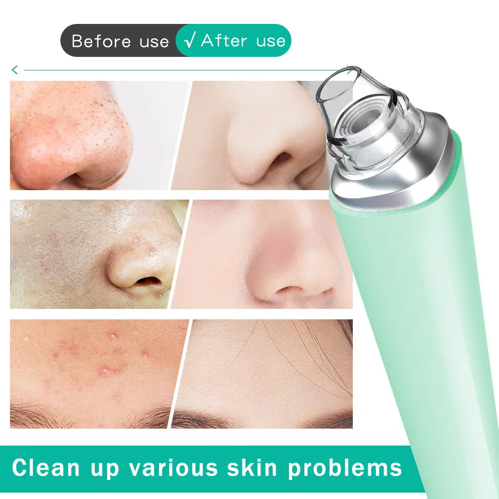 USB Rechargeable Vacuum Pimple Extractor Machine - Bellarte Enchanté USB Rechargeable Vacuum Pimple Extractor Machine